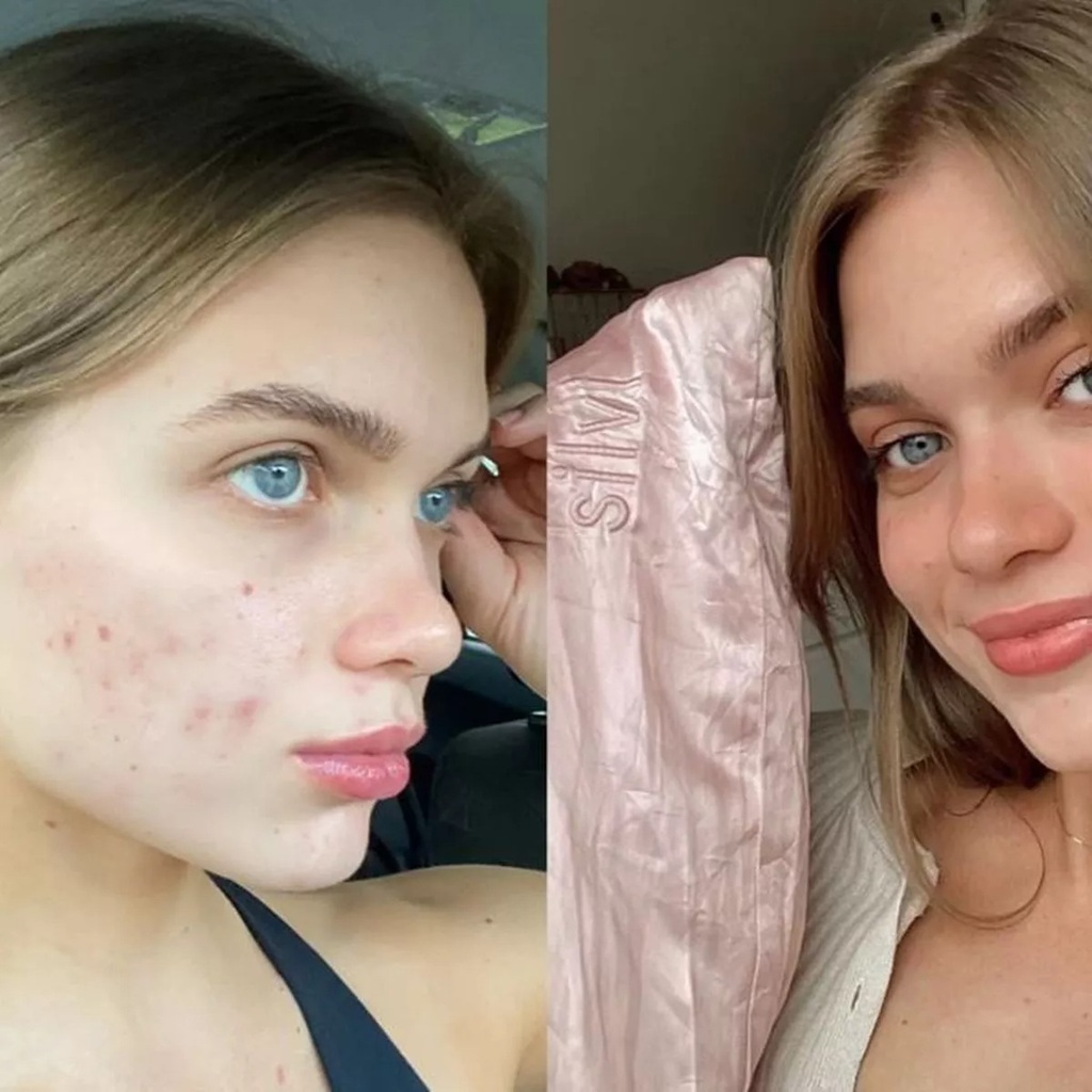 Do pillowcases really cause acne